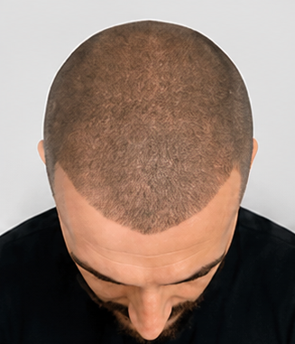 Scalp micro pigmentation results after treatment image one