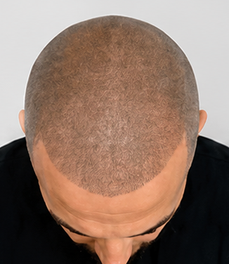 SMP after image for realistic shaved hair look