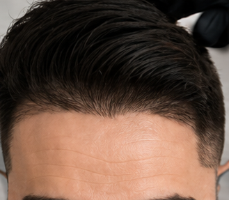 Hairline restoration service